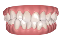 dentes_apinhados-jpg-removebg-preview.png